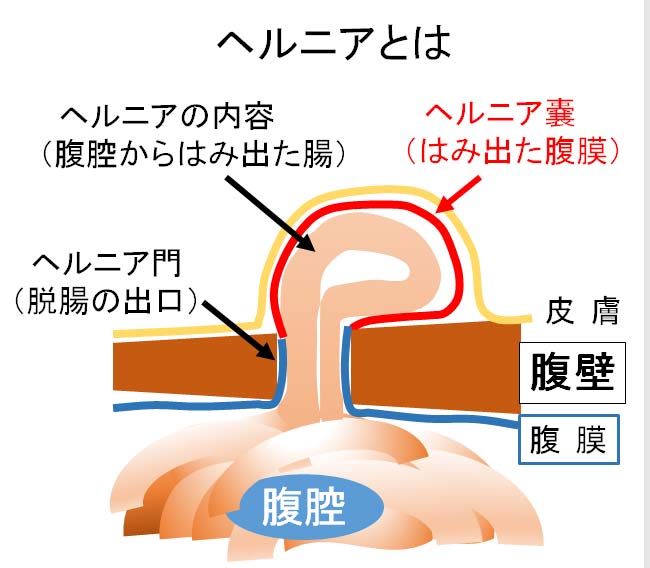 鼠径ヘルニア（脱腸）の手術｜身体への負担が少ないSILS-TEP法って？｜ブログ｜Gi外科クリニック