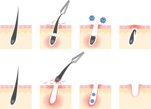 毛を抜くことで起こるリスク？毛抜きによる毛穴や肌の危険性と脱毛の良さ｜オーシャンズ｜心斎橋・大阪梅田のメンズ専門脱毛サロン