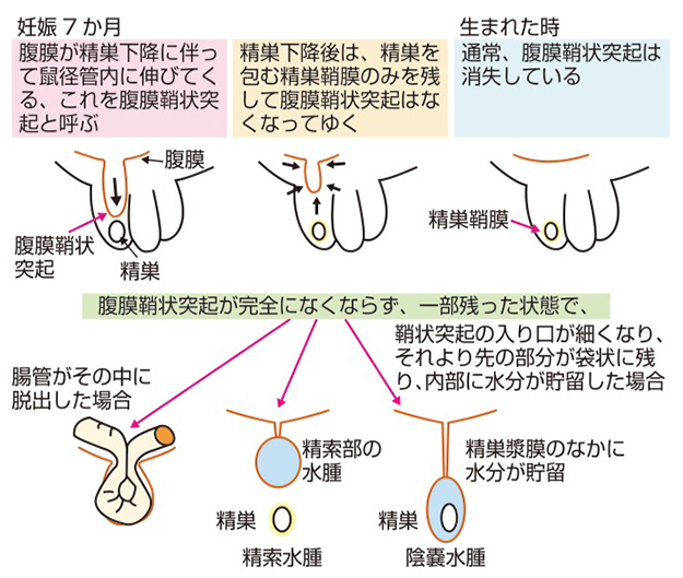 奈良市でそけいヘルニア・脱腸の日帰り手術【Gi外科クリニック京都院】