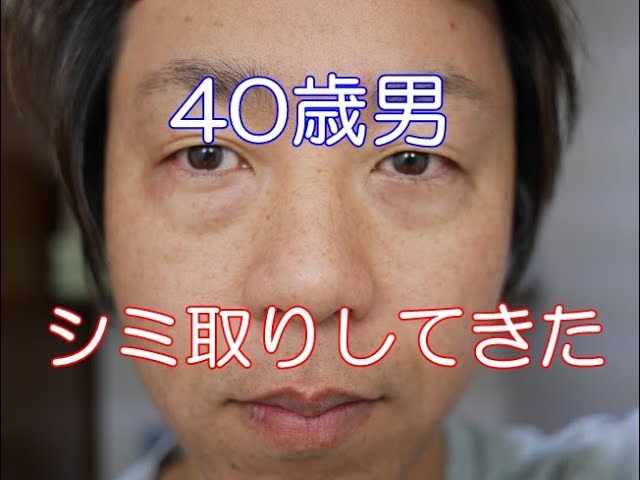 40代男性】脂肪吸引（顔3部位）＋バッカルファット除去｜5ヵ月後｜ 美容整形・美容外科 | ジョウクリニック【公式】