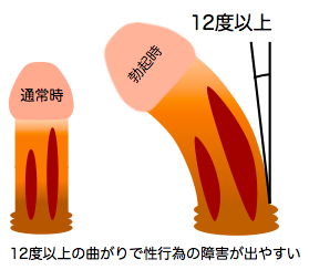 泌尿器科の専門医が徹底解説】ペニスの曲がりは治療が必要？原因・リスク・治療法まで