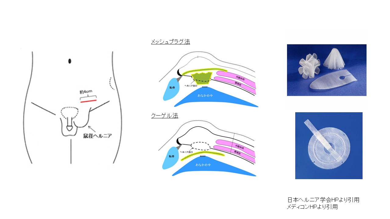 歩くと痛む鼠径部｜腰痛のツボ｜ツボネット 鍼灸の症例が検索できるツボ辞典