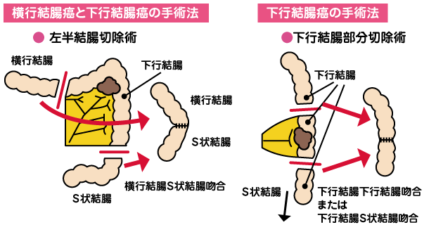 大腸がんの最新治療法 | 神戸市垂水区／消化器(胃・大腸)／内視鏡検査、腹腔鏡手術、抗がん剤治療は佐野病院