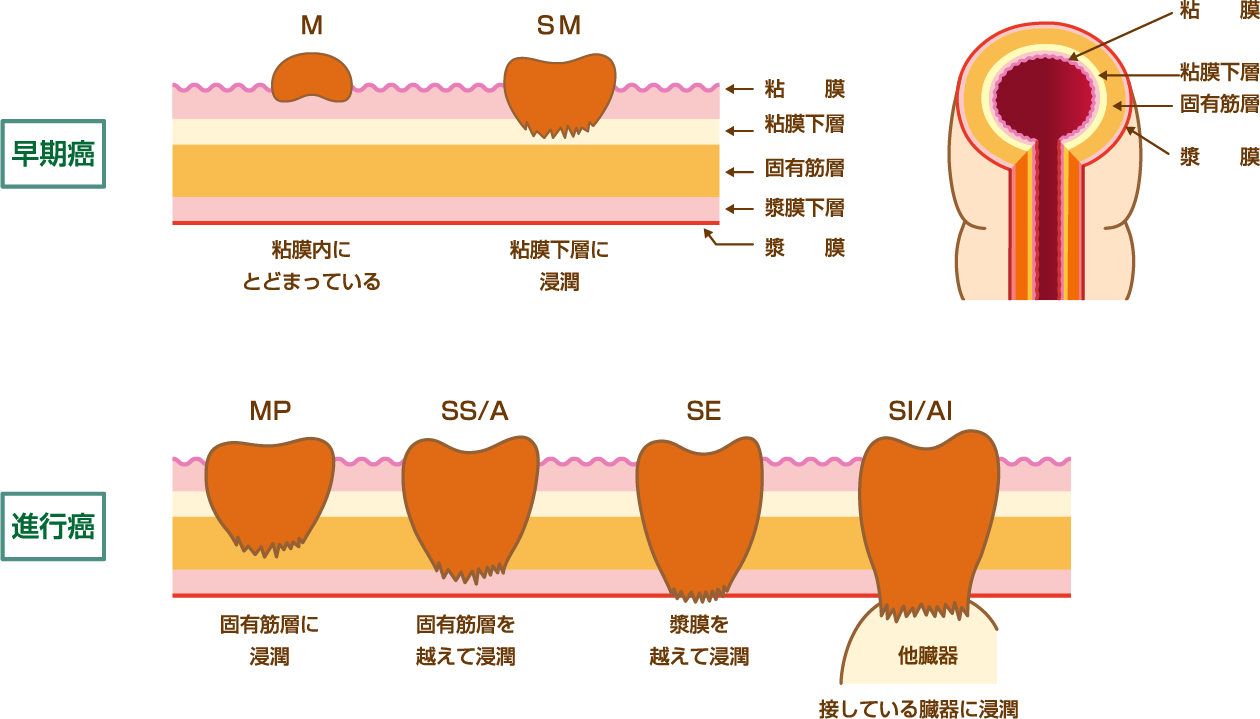 大腸がん | 新松戸中央総合病院