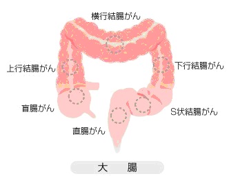 大腸がん | 見のがすな！がんのサイン | 大鵬薬品工業株式会社