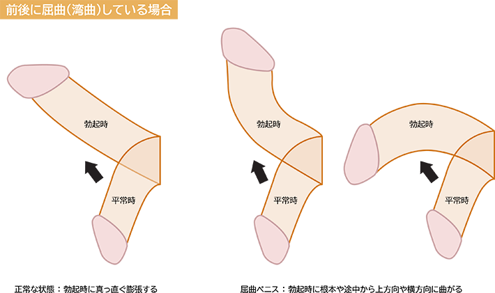 長さだけじゃない】ペニスを太くする方法で女性の満足度をアップさせる｜あんしん通販コラム