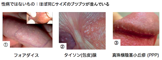 真珠様陰茎小丘疹は内服薬や外用薬で治るのか？ - アモーレクリニック