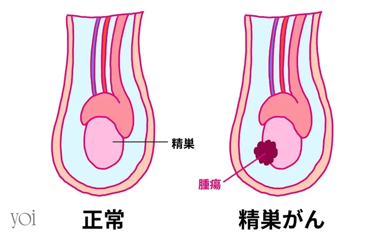 短小包茎って何？短小包茎の原因やデメリット、治療法を解説！│Welcy｜健やかな人生を毎日送るための情報共有メディア