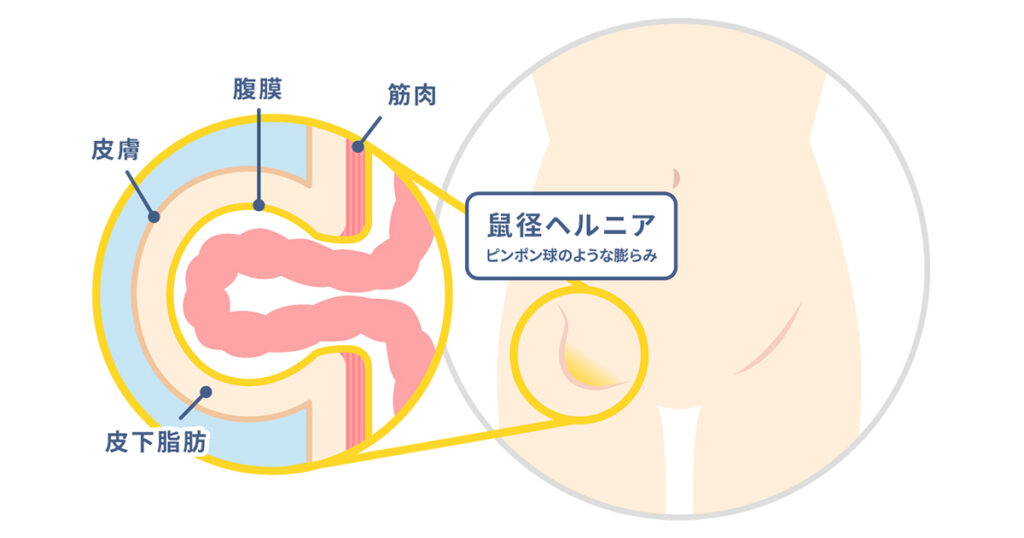 痛みの研究 鼠径部2 | エコーガイドでfasciaハイドロリリース