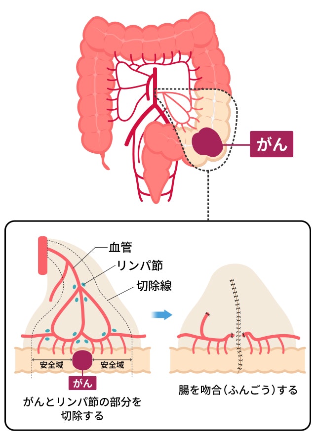 S状結腸捻転【画像診断シリーズ16】｜鹿児島市の脳神経外科 ひらやま脳神経外科