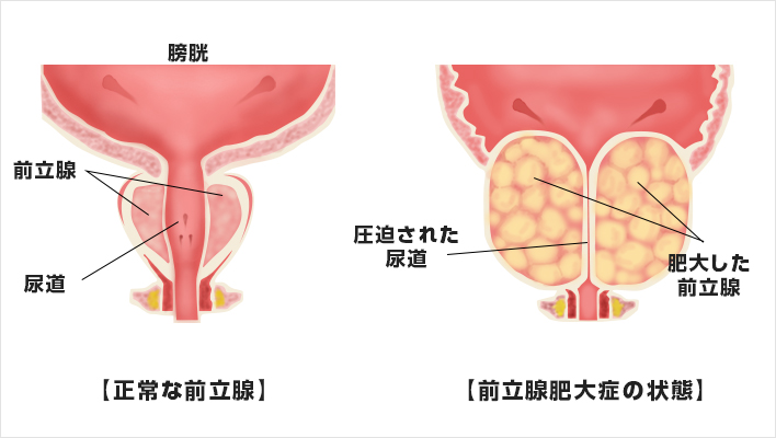 風俗の前立腺マッサージって？プレイのやり方と注意点を解説！ | FQSS