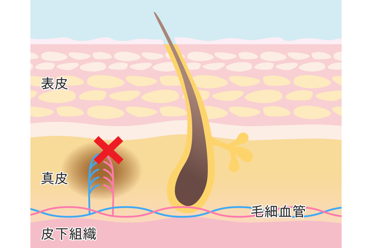 すぐに隠したい時に使えるキスマークの上手な消し方と言い訳テクニック｜@DIME アットダイム