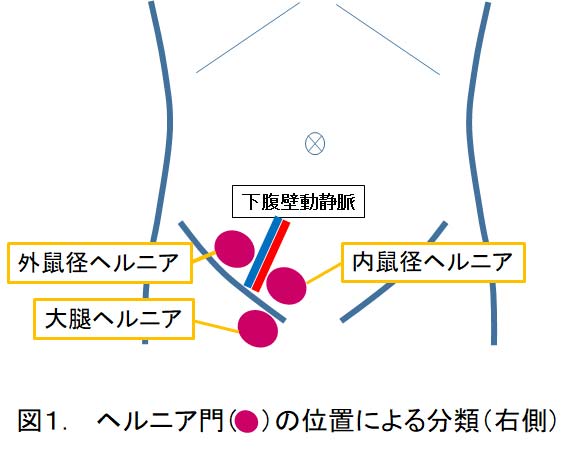 鼠径ヘルニア | 倉敷市