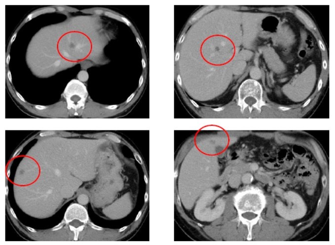 画像あり】S状結腸軸捻転とは？原因、症状、CT、治療まとめ！