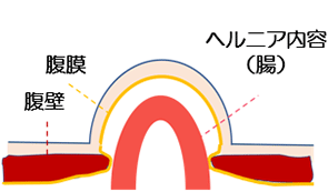 奈良県の鼠径ヘルニア・脱腸の患者さまに当院が選ばれる理由