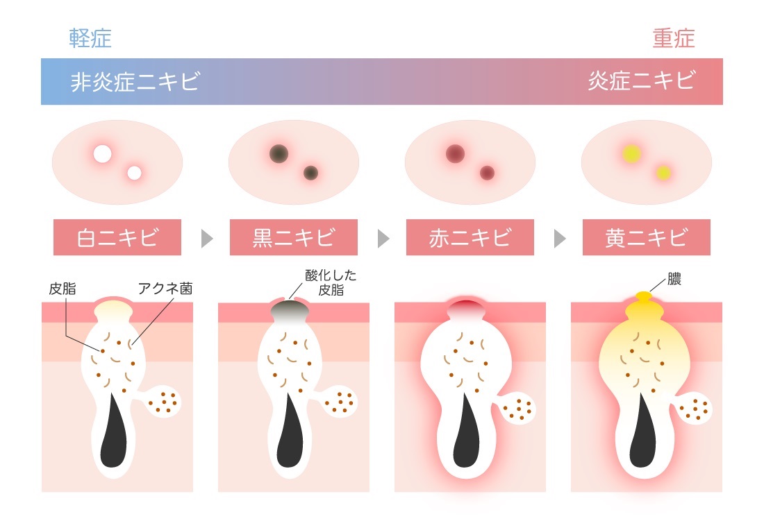 ニキビに効く】 話題沸騰中のコスメ〜真似したいメイク方法の口コミが556件！デパコスからプチプラまで（3ページ目） | LIPS