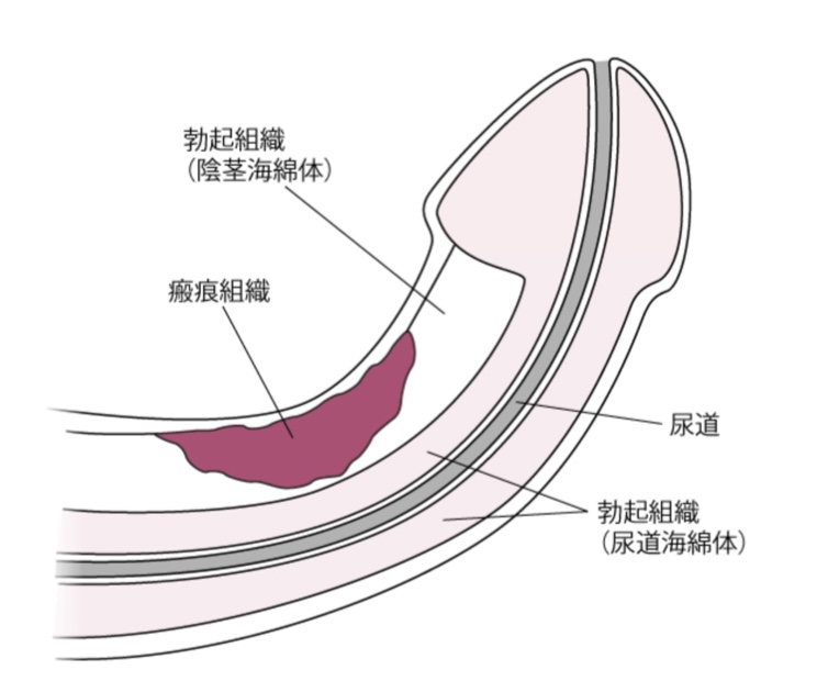 勃起 - Wikipedia