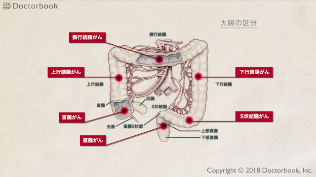 THUNDERBEATを用いた潰瘍性大腸炎（S状結腸癌合併）に対する大腸全摘術、直腸がんに対する側方リンパ節郭清 - Olympus