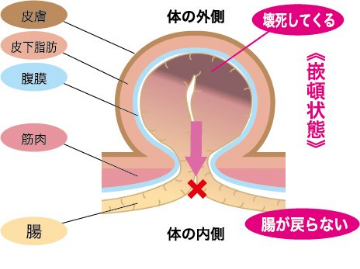 グロインペイン症候群（鼡径部痛症候群） 岡山市南区中区ジール整骨院｜痛みの原因がわかる整体｜岡山市南区泉田岡山市中区平井