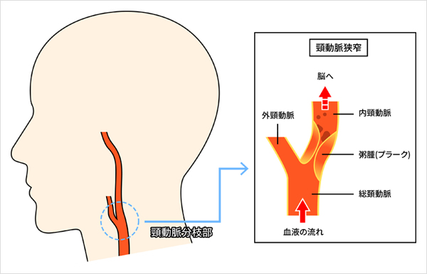 後ろから首を絞められた！｜力のいらない護身術｜ALSOK