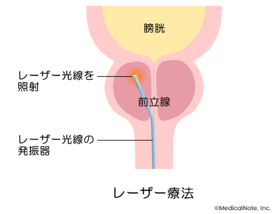 前立腺肥大症 | 北海道泌尿器科記念病院