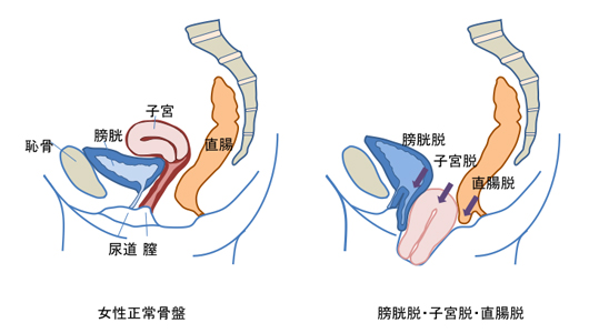 女性編】おしっこが痛い！泌尿器科医が痛みを感じるタイミングごとに解説 - 医療法人神楽岡泌尿器科