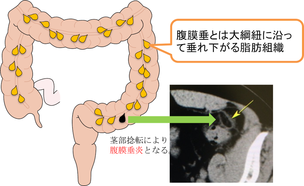 浸水法」で患者の苦痛なく、S状結腸を通過：Cadetto.jp