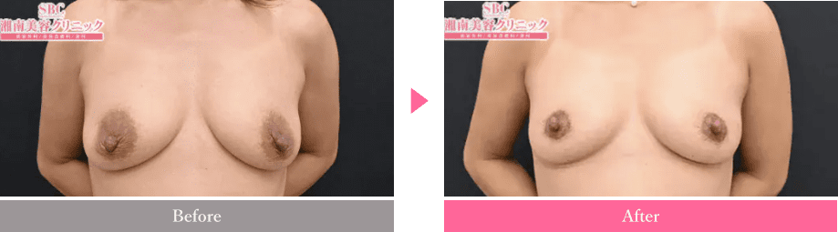 乳輪が大きい人の原因7選！小さくする方法とおすすめケアクリームを紹介！ | 女子のカガミ