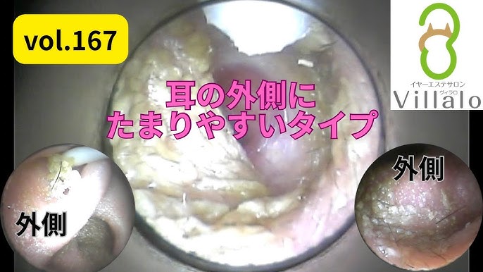 右も左もたっぷり耳垢取れました(*'▽')／＿耳掃除・耳かき動画_Earwax Removal