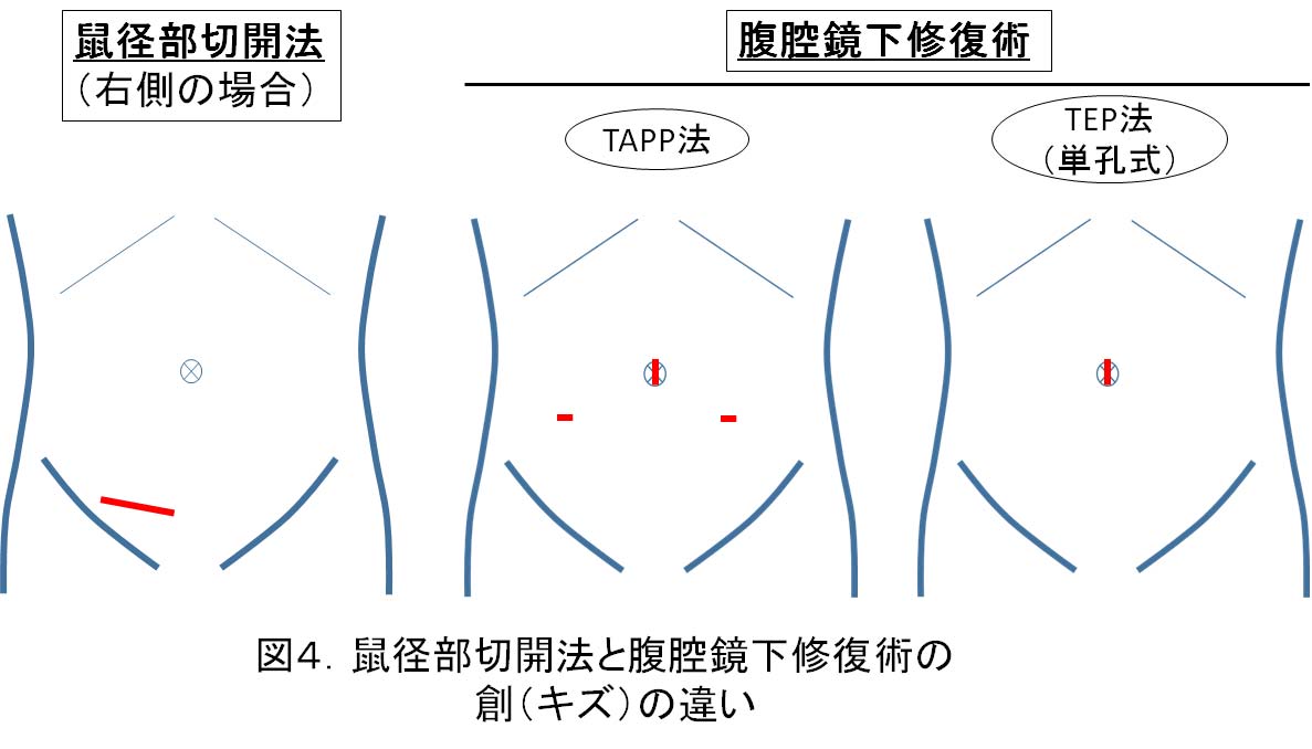 鼠径ヘルニア | 倉敷市 チクバ外科・胃腸科・肛門科病院