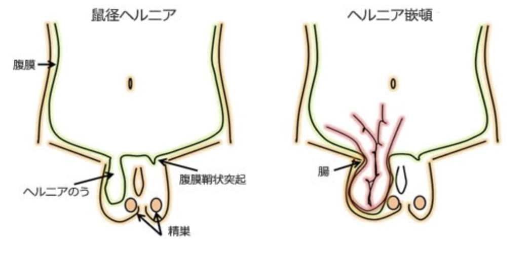 鼠径ヘルニア・陰嚢水腫 | 聖マリアンナ医科大学 横浜市西部病院