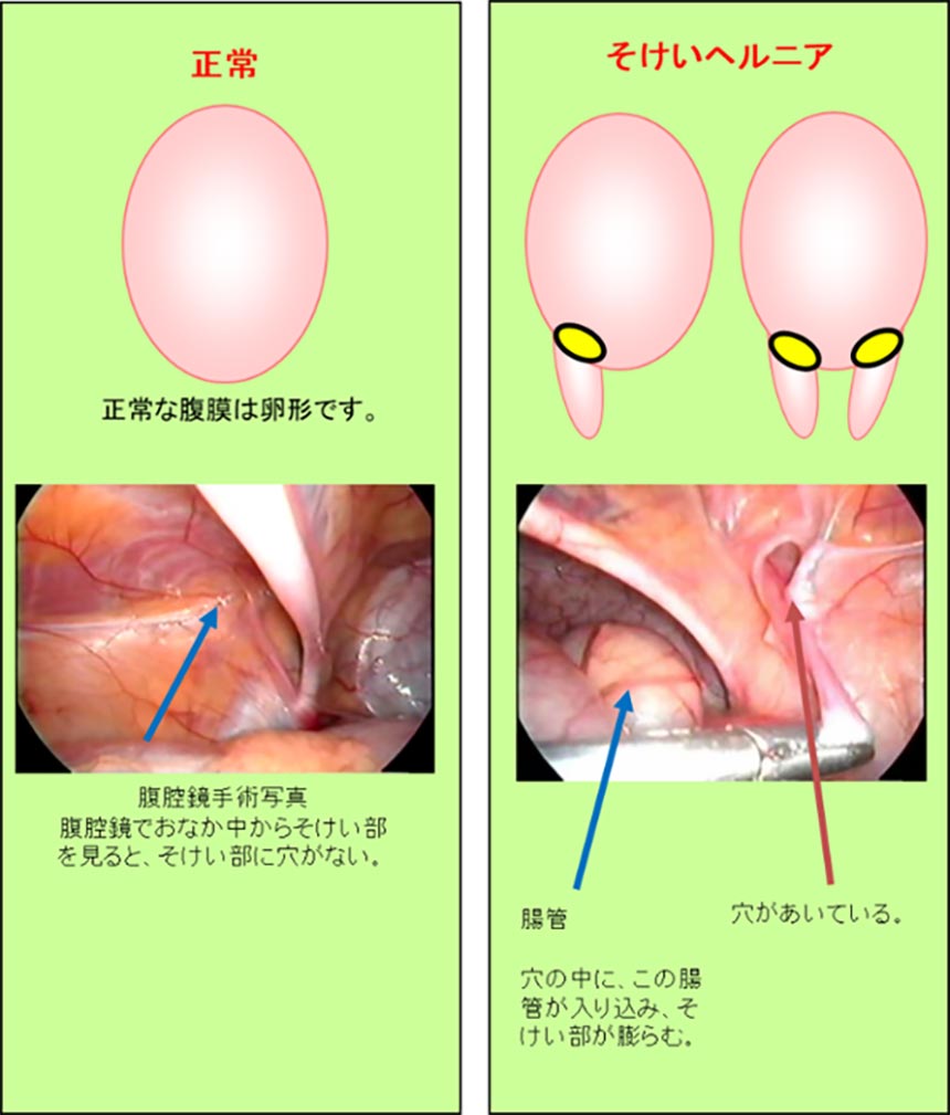 小陰唇のびらびらの色が黒いとお悩みの方へ【症例写真つき】｜スワンクリニック銀座