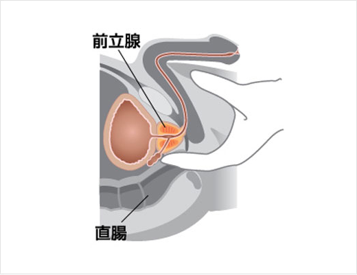 前立腺全摘術を受けられる患者様へ