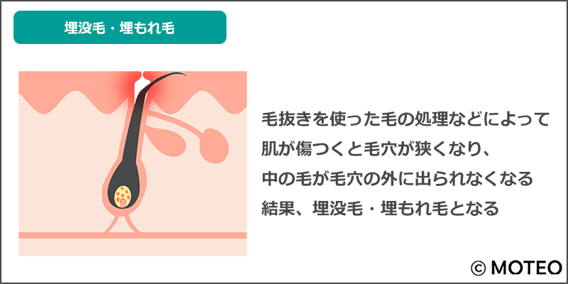 事実】髭を抜くと生えなくなる？髭が薄くなる？それは嘘です…。 - やってみたブログ