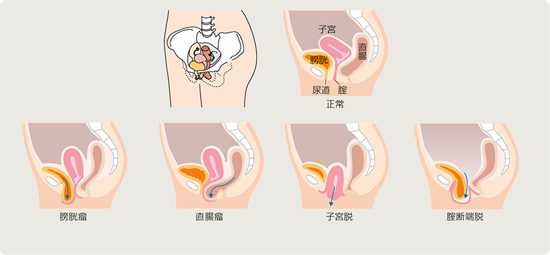 骨盤臓器脱（子宮脱、膀胱瘤など） | 代表的疾患 |