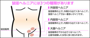 鼠径部ヘルニアの手術方法 - そけいヘルニアノート