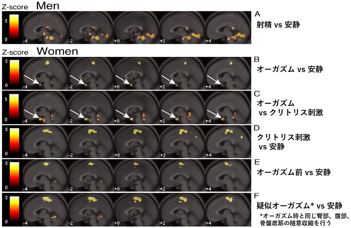 公式】EMSELLA®｜尿失禁・尿漏れに関するお悩み、エムセラ®のメカニズム