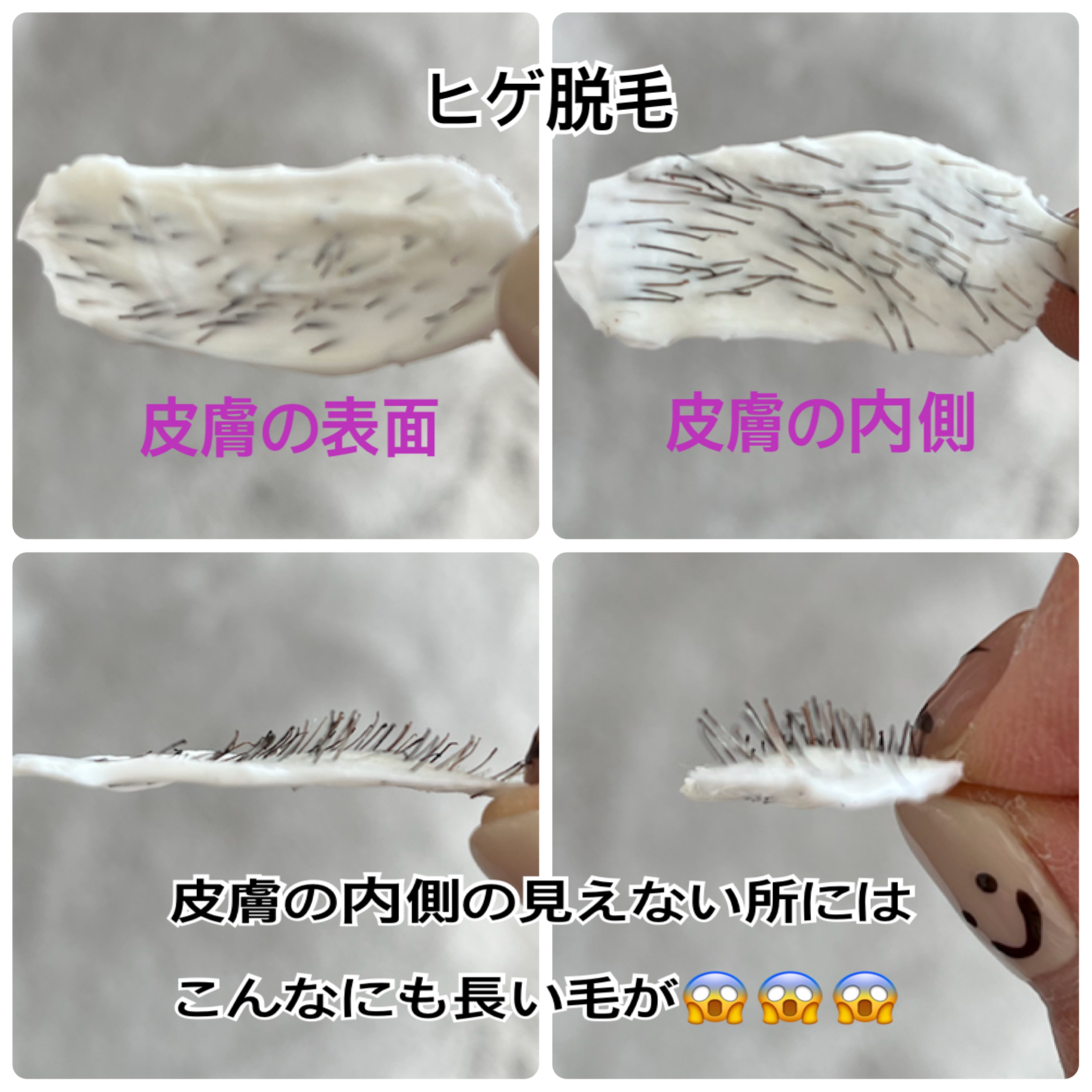 ヒゲ脱毛は痛い？部位別の痛みの感じ方や軽減方法を解説