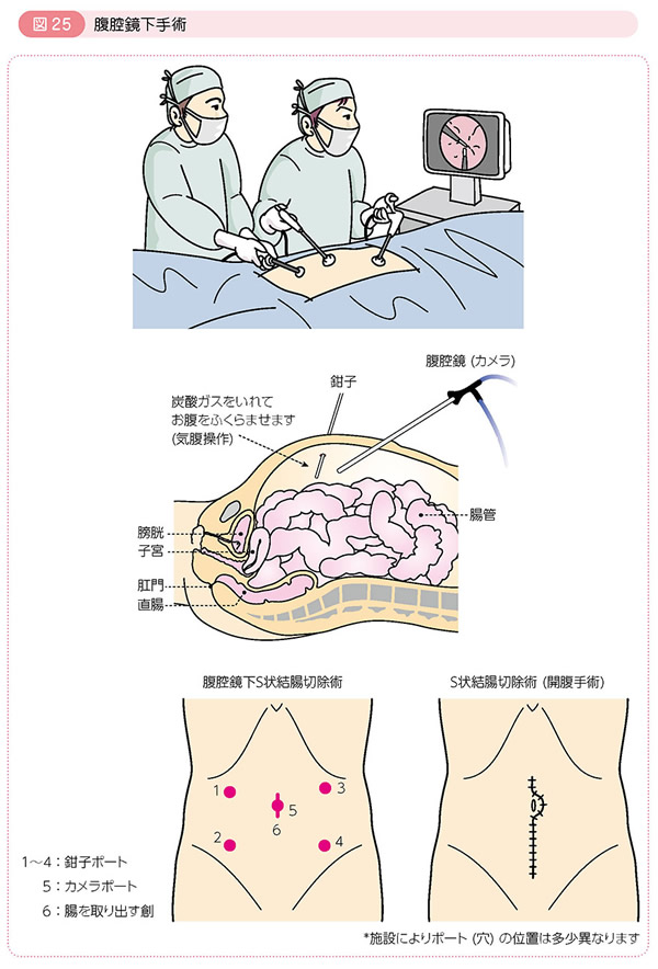 軟性S状結腸鏡検査」だけでも大腸がんリスク減少：話題の論文 拾い読み！：日経Gooday（グッデイ）