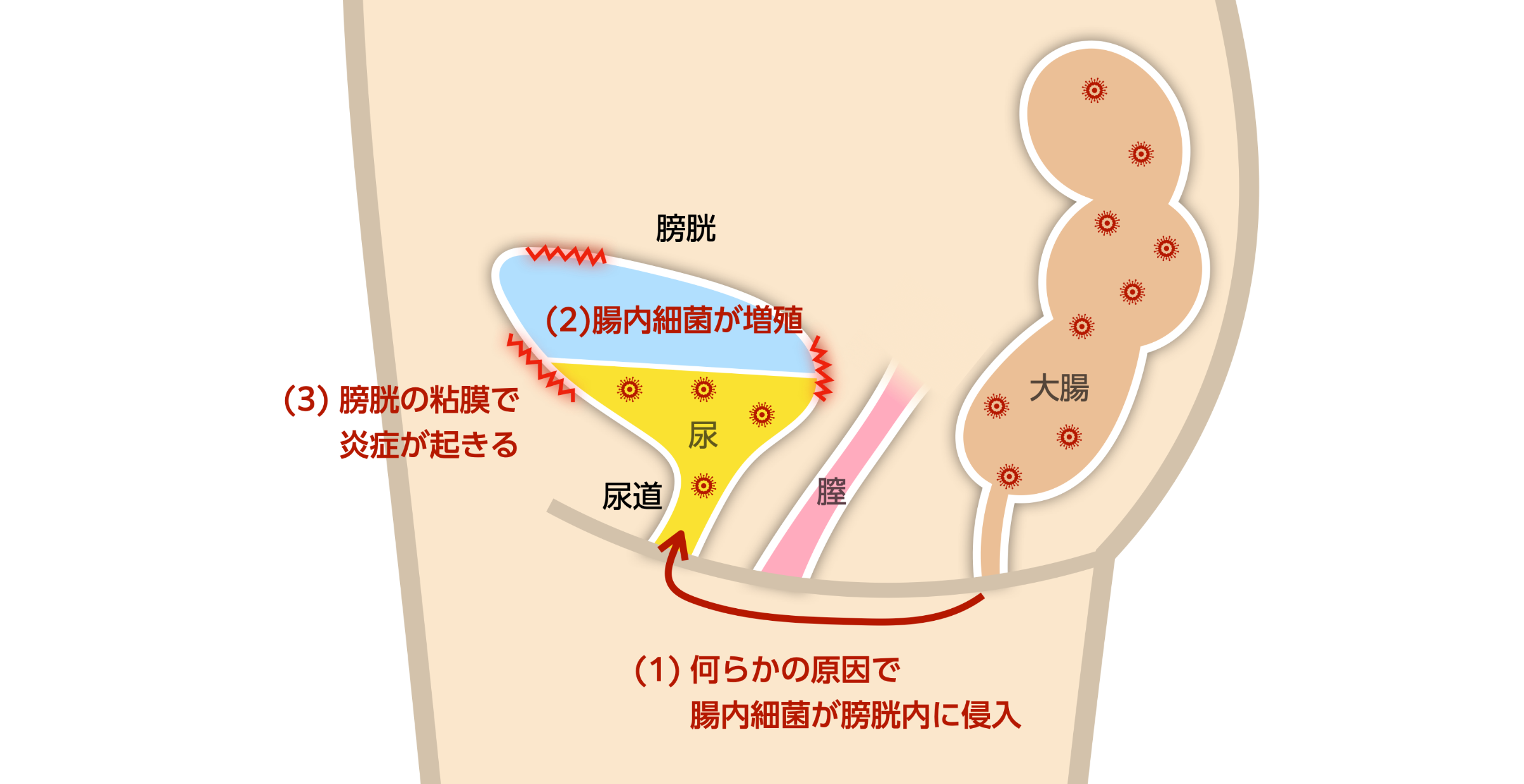 過活動膀胱 | 泌尿器科の主な疾患と治療方法 |