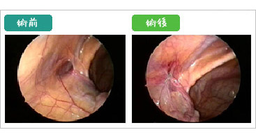 そけいヘルニア（脱腸） ｜ 渡辺胃腸科外科病院