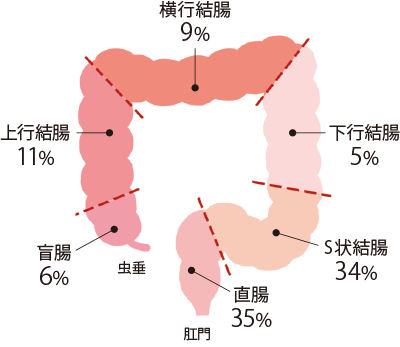 下部消化管 – 腹腔鏡・ロボット支援結腸・直腸がん手術 | 消化器外科