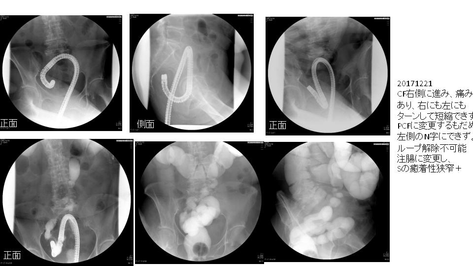 大腸がん - 性病検査キットを使って自宅で簡単検査 GME医学検査研究所