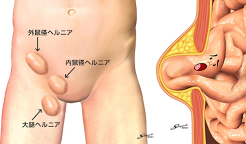 奈良県の鼠径ヘルニア・脱腸の患者さまに当院が選ばれる理由