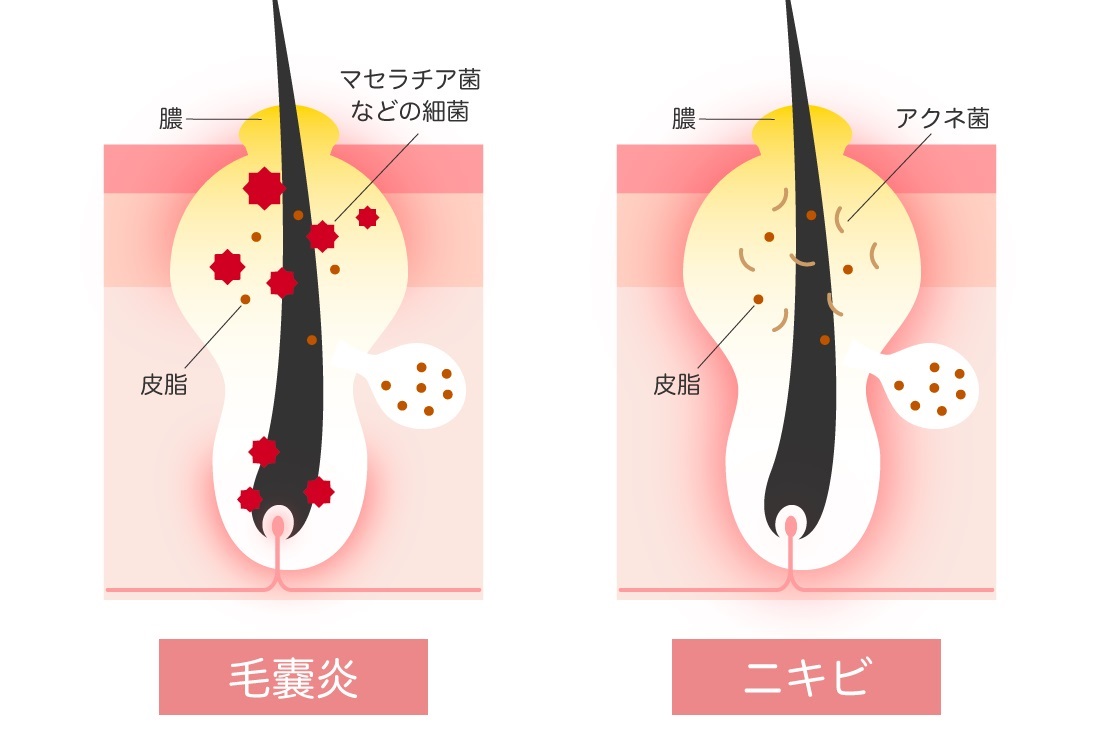 背中ニキビケアの最強ボディスクラブおすすめ