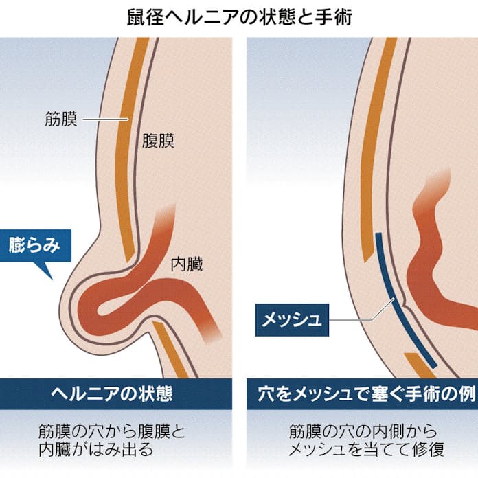 最新版 鼠径部ヘルニア分類(新 JHS 分類)｜ALOHA外科クリニック院長ブログ