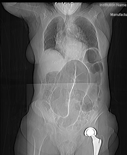 大腸がんはどこにできるのか？｜大腸がんサポートnavi｜武田薬品