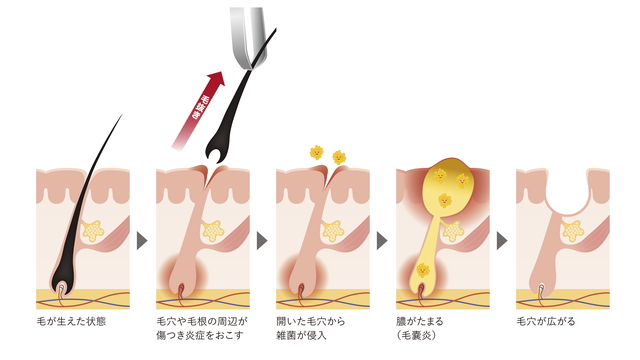 ヒゲの毛抜きは危険？デメリットとヒゲのおすすめ処理方法を解説 | レーザースキンクリニック