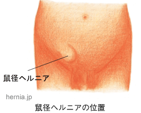 疾患啓発資材設置にご協力をお願いします - そけいヘルニアノート