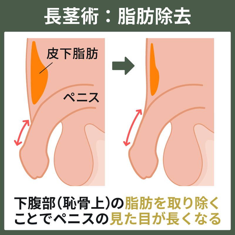 大きさで悩んでいるのはばかみたい…「亀頭増大術」をやってみた！｜日刊ゲンダイDIGITAL